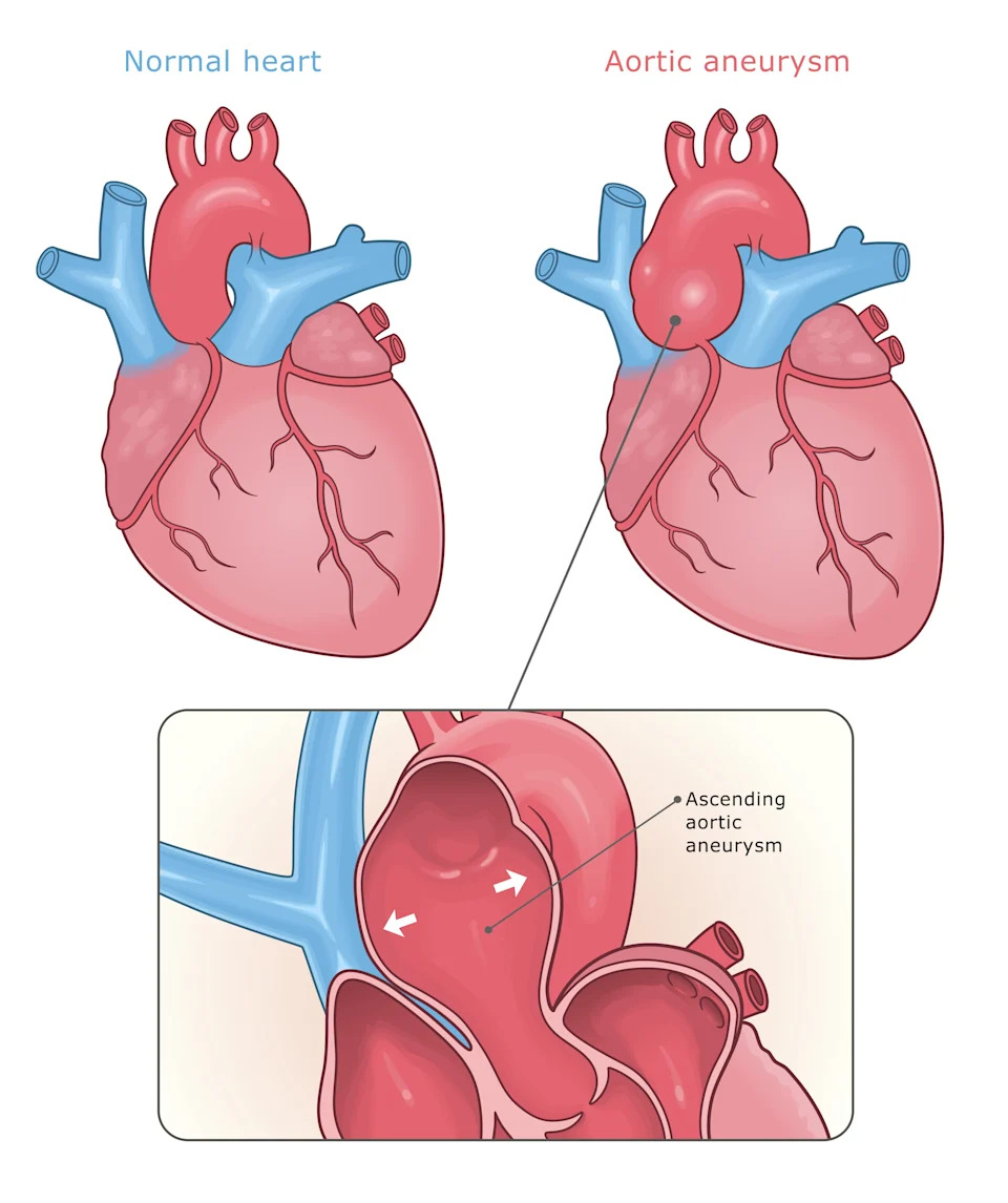 Diagram comparing a normal heart to one with an aortic aneurysm, highlighting the enlarged aorta section